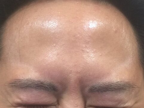 浜松　ボトックス注射