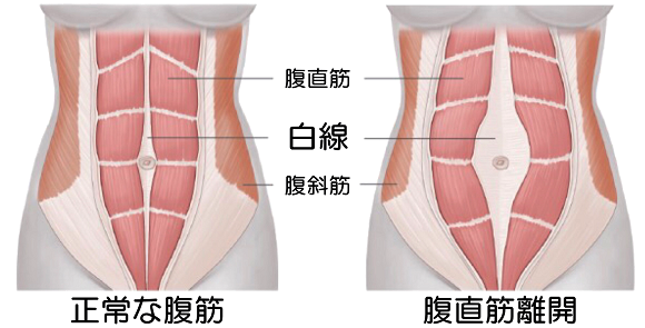 浜松　腹直筋離開 