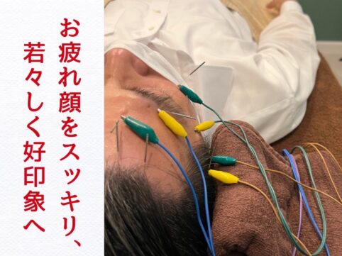 浜松美容鍼