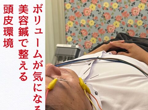浜松　頭皮ケア　美容鍼